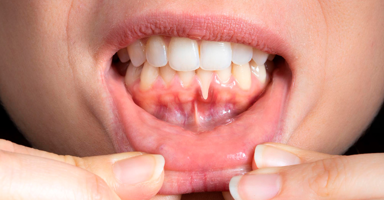 Симптомы рецессии десны.