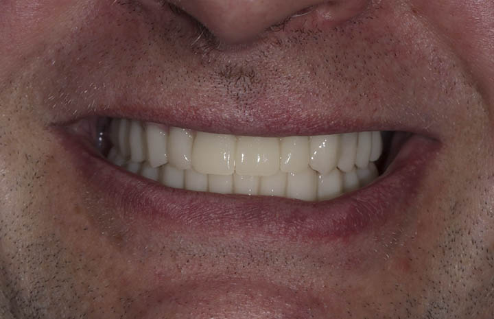 Решение проблемы с отсутствием зубов на верхней и нижней челюсти — по системе ReSmile