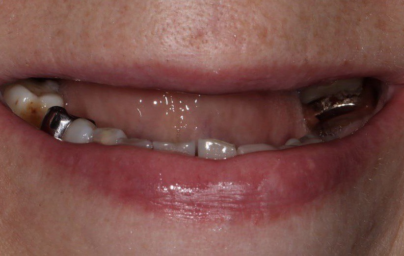 Решение проблемы пациента с отсутствующими зубами на верхней и нижней челюсти