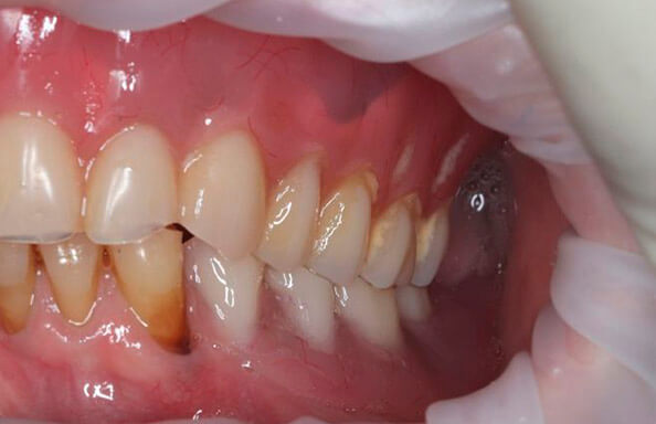 Съемный протез на жевательные зубы