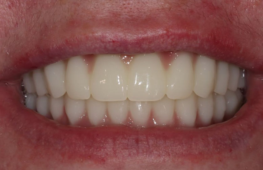 Комплексная реабилитация верхней и нижней челюсти по системе Resmile