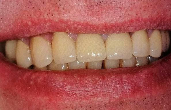 Протезирование МК-коронками на своих зубах