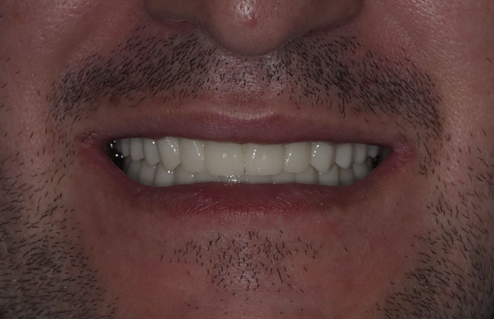 Лечение отсутствия зубов на верхней и нижней челюсти