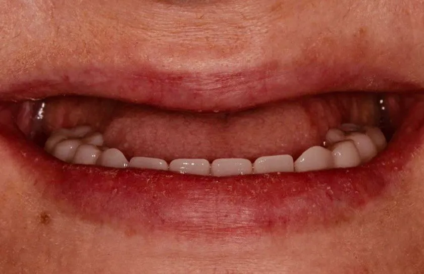 Фото работ - Имплантация зубов на верхней челюсти