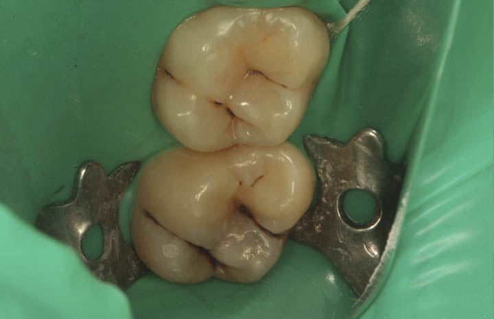 Фото работ - Лечение боли и восстановление анатомической формы зубов