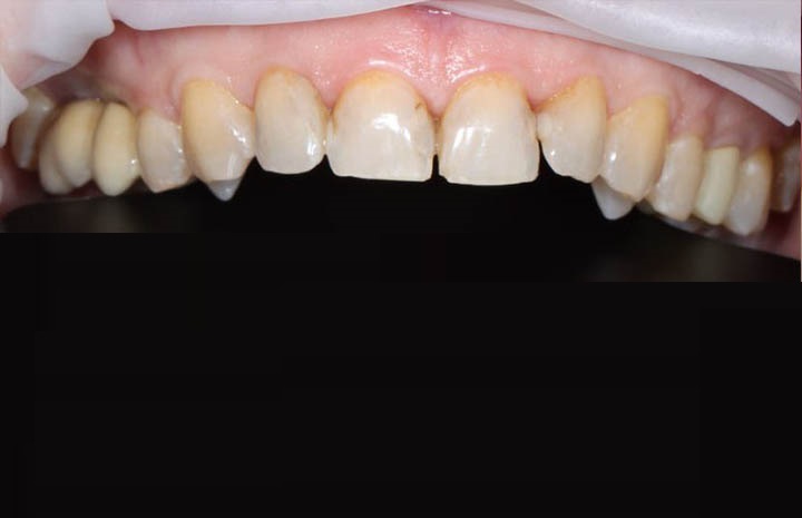 Установка виниров на 6 фронтальных зубов