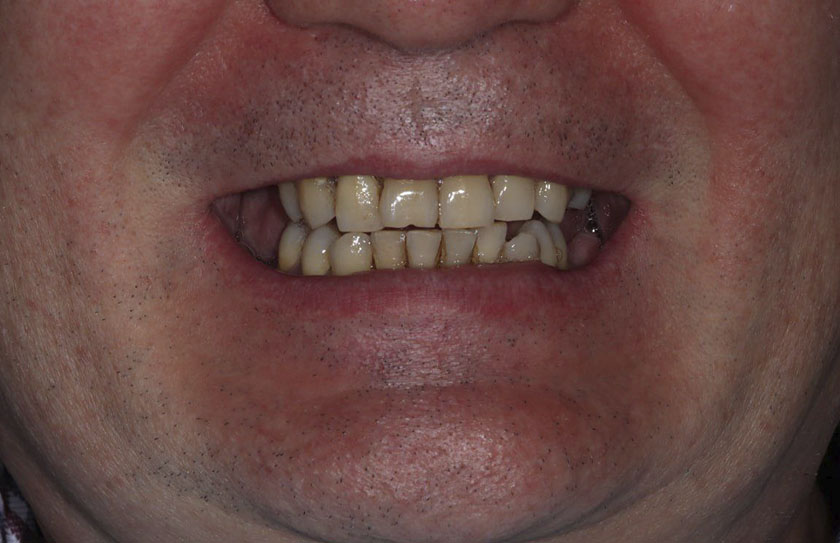 Лечение частичного отсутствия зубов на верхней и нижней челюсти