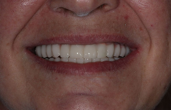 Решение проблемы отсутствия зубов на верхней и нижней челюсти