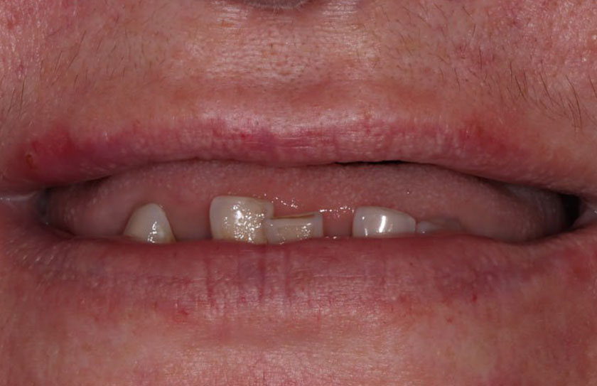 Комплексная реабилитация верхней и нижней челюсти по системе Resmile