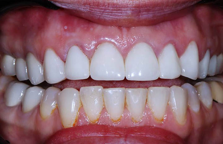 Фото работ - Исправление неудовлетворительного внешнего вида и дефектов зубов с помощью виниров и керамических коронок