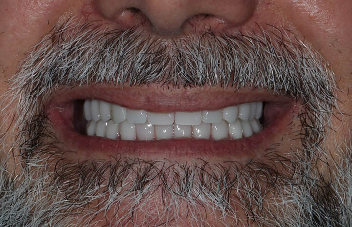Комплексная реабилитация на верхней и нижней челюсти по системе Rеsmilе