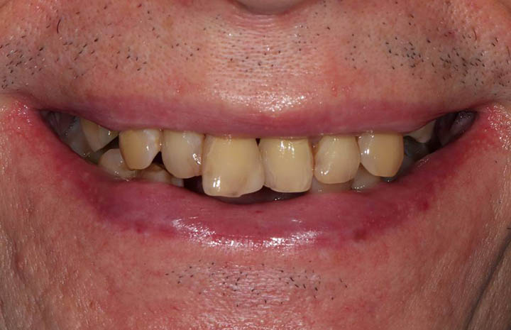 Фото работ - Решение проблемы с отсутствием зубов и восстановление эстетических дефектов