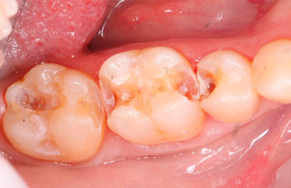 Фото работ - Лечение глубокого кариеса в зубах