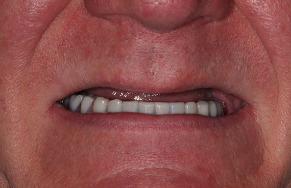 Фото работ - Решение проблемы отсутствия зубов на верхней челюсти