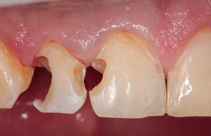 Лечение кариеса и восстановление формы зубов прямой реставрацией