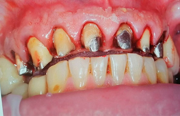 Протезирование МК-коронками на своих зубах