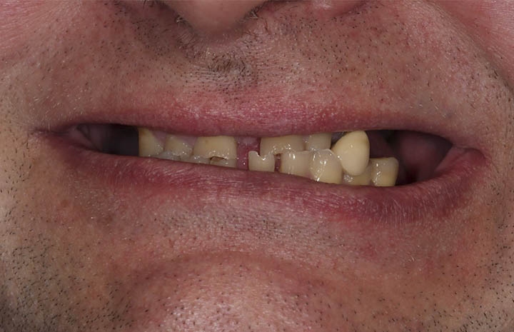 Решение проблемы с отсутствием зубов на верхней и нижней челюсти — по системе ReSmile