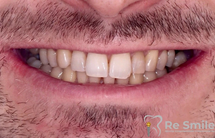 Керамические виниры E-max: установка на передних зубах на верхней и нижней челюсти