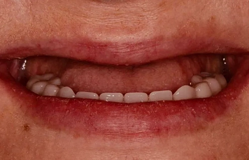 Имплантация зубов на верхней челюсти - фото лечения