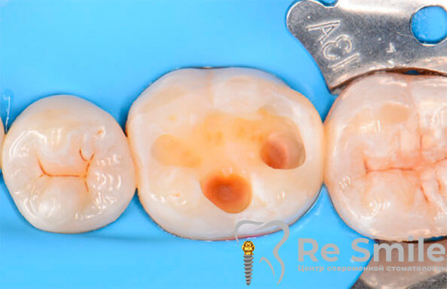 Восстановление зуба с помощью керамической вкладки
