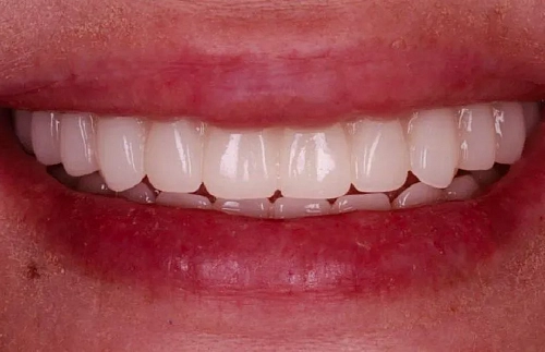 Имплантация зубов на верхней челюсти