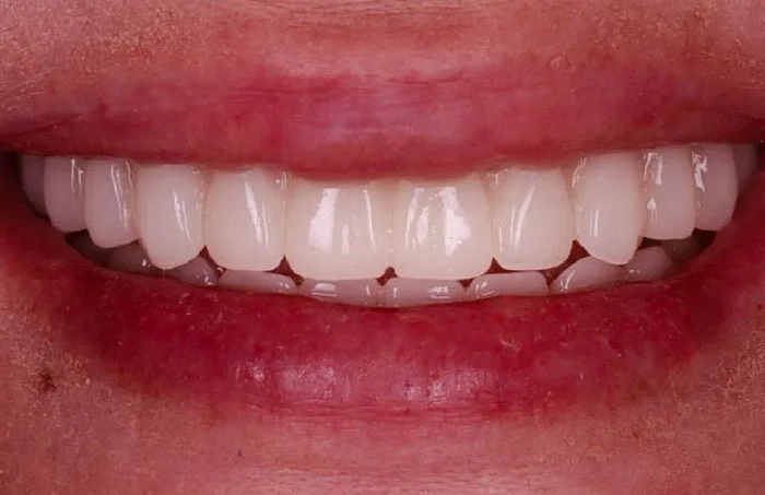 Фото работ - Имплантация зубов на верхней челюсти