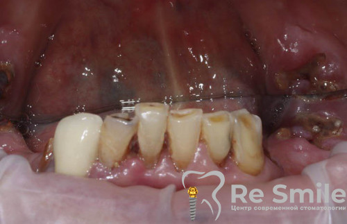 Комплексное восстановление жевательной функции и эстетики нижних зубов