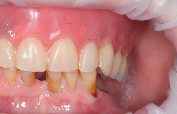 Фото работ - Съемный протез на жевательные зубы