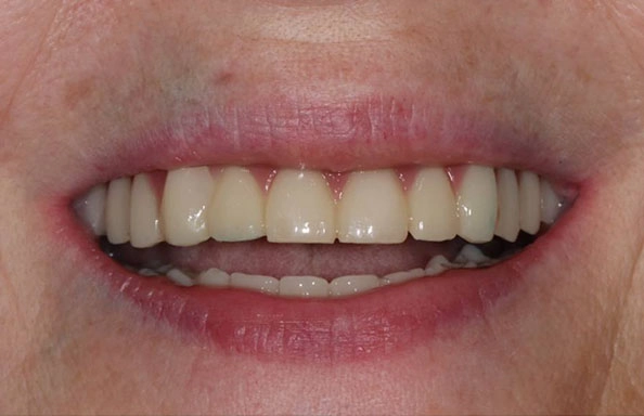 Фото работ - Комплексная имплантация на верхней челюсти и на нижней по методике ALL-on-6