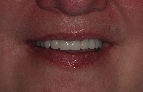 Фото работ - Восстановление зубов верхней и нижней челюсти