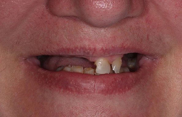Фото работ - Восстановление зубов верхней и нижней челюсти