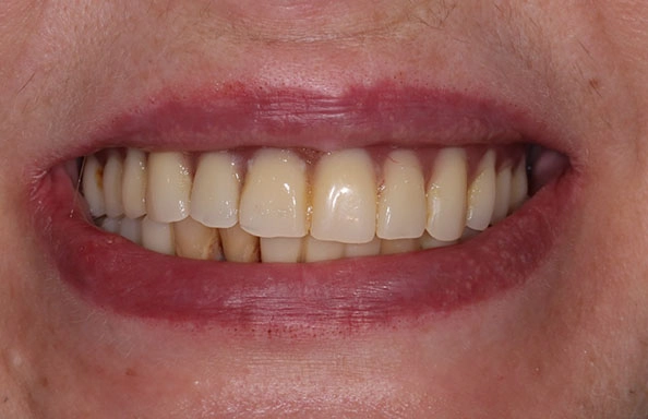 Фото работ - Комплексная реабилитация на нижней челюсти по системе Resmile