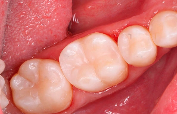 Фото работ - Лечение глубокого кариеса в зубах