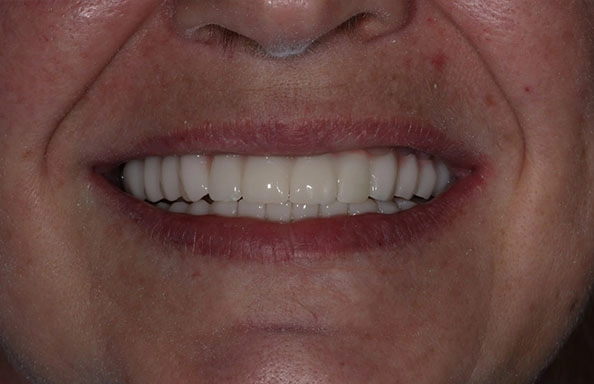 Фото работ - Решение проблемы отсутствия зубов на верхней и нижней челюсти