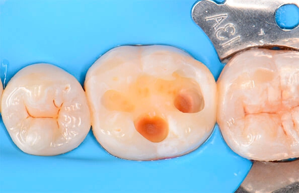 Фото работ - Восстановление зуба с помощью керамической вкладки