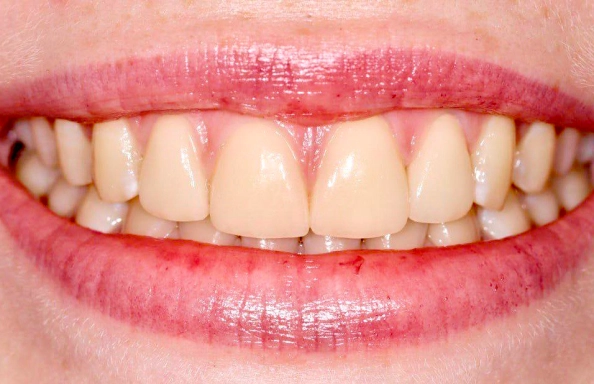 Фото работ - Установка виниров на центральные зубы верхней челюсти