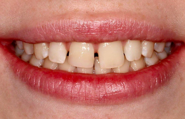 Фото работ - Установка виниров на центральные зубы верхней челюсти