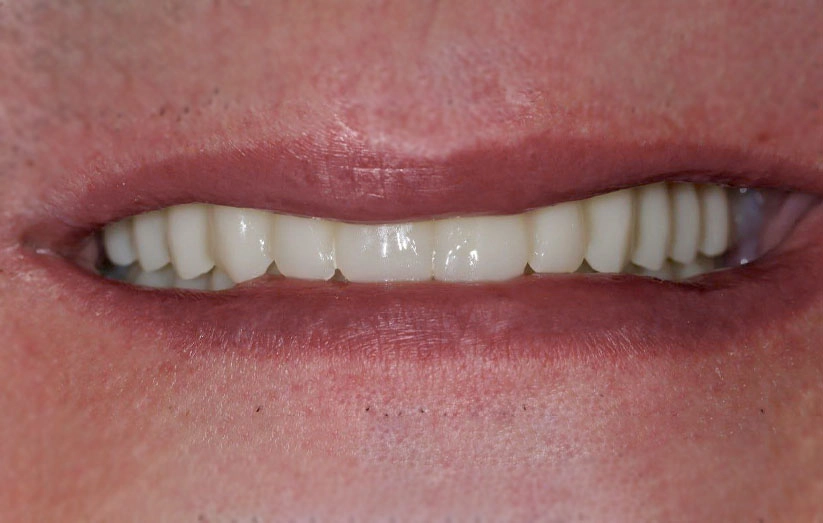 Имплантация при частичном отсутствии зубов