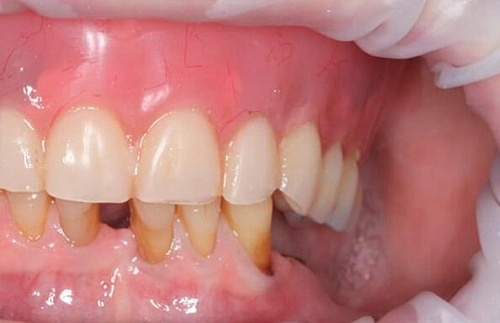 Съемный протез на жевательные зубы фото работ