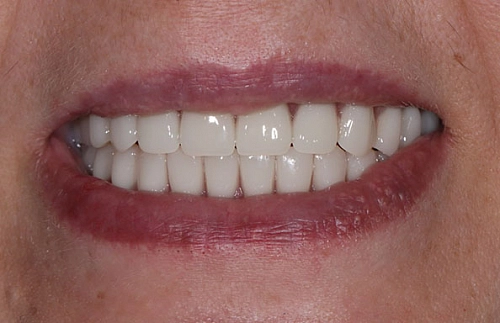Комплексная реабилитация на нижней челюсти по системе Resmile