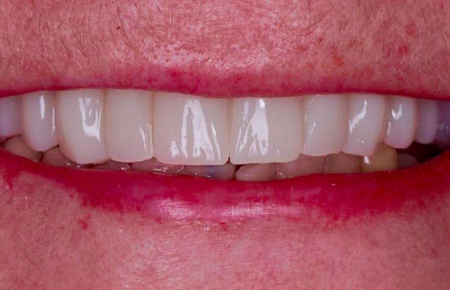 Одноэтапная имплантация All-on-8 на верхней челюсти фото лечения