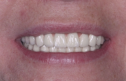 Перепротезирование верхней и нижней челюсти  - фото лечения в стоматологии