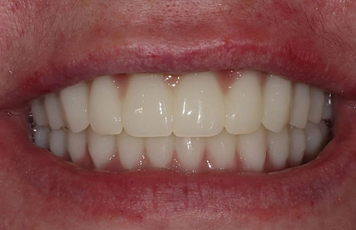Комплексная реабилитация верхней и нижней челюсти по системе Resmile фото лечения