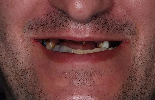 Лечение отсутствия зубов на верхней и нижней челюсти - фото лечения в клинике Resmile 