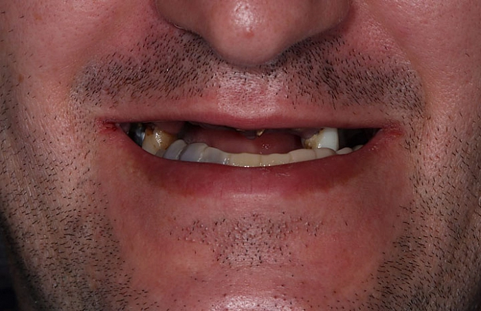 Фото работ - Лечение отсутствия зубов на верхней и нижней челюсти