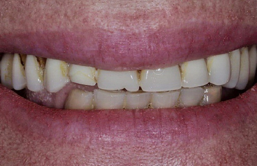 Имплантация all-in-6 на нижней и верхней челюсти фото лечения