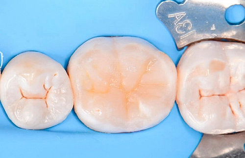 Восстановление зуба с помощью керамической вкладки - фото работ