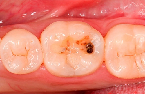 Лечение кариеса жевательного зуба - фото работ