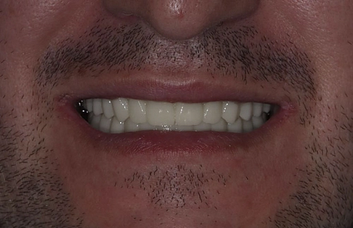 Лечение отсутствия зубов на верхней и нижней челюсти - фото лечения в клинике Resmile 