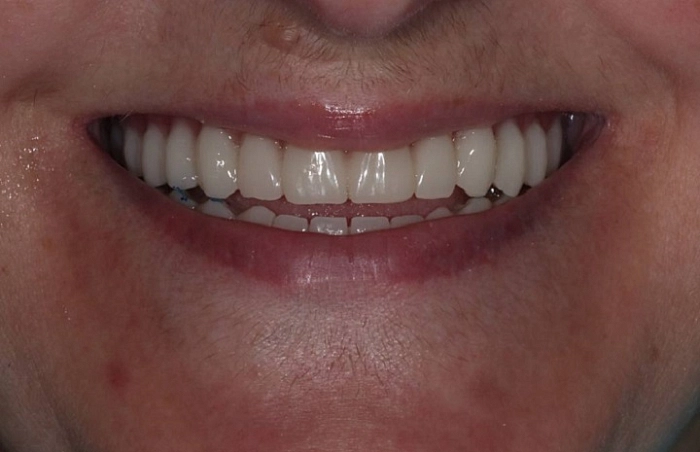 Фото работ - Решение проблемы отсутствия зубов у пациентки